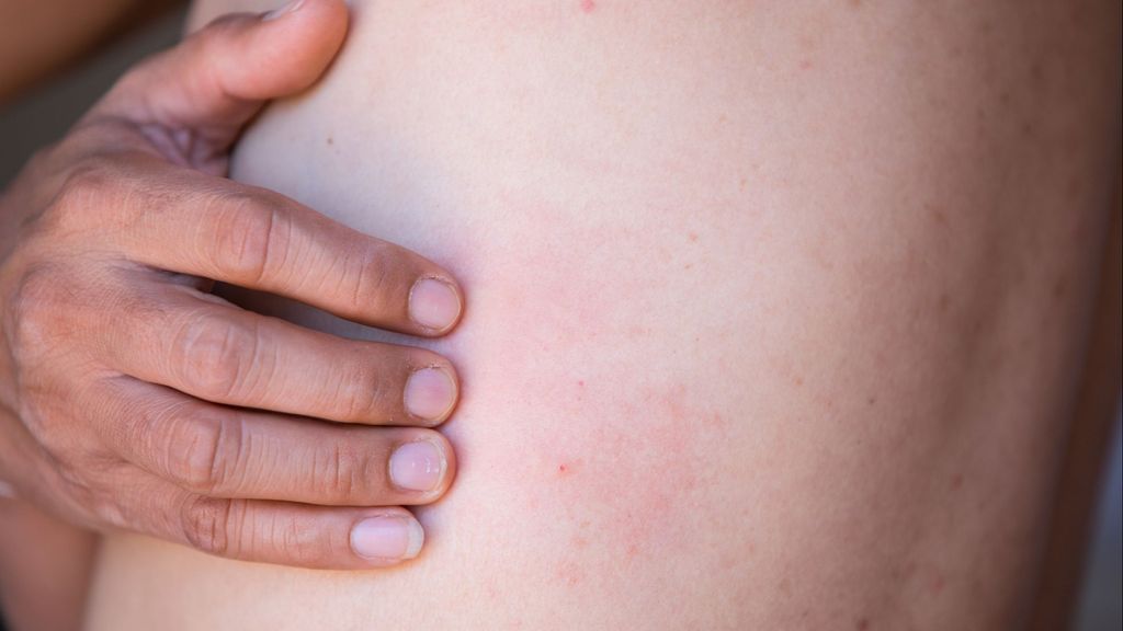 Síntomas de urticaria