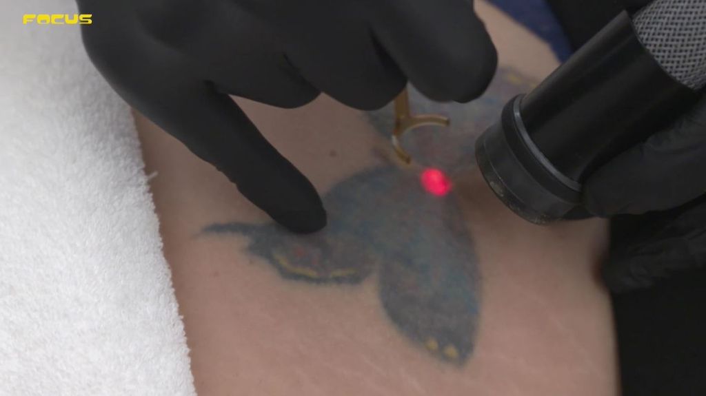 La realidad sobre la eliminación de los tatuajes con láser: "Puede conllevar daños irreparables"