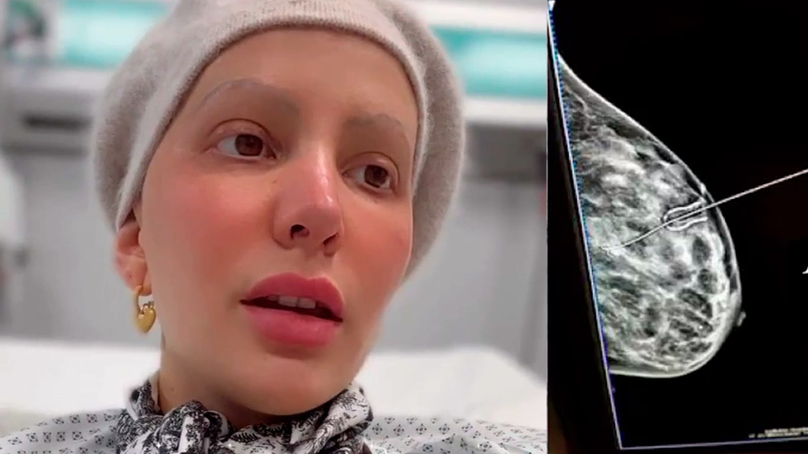 Aylén Milla se somete a una mastectomía parcial por su cáncer de mama Aylén Milla se somete a una mastectomía parcial por su cáncer de mama