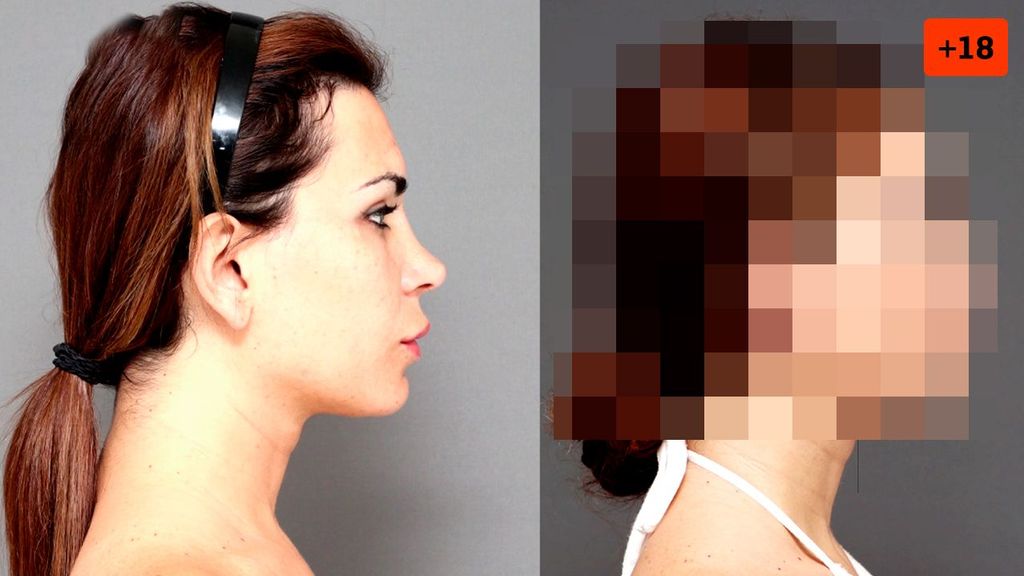 Daniela Requena se somete a una frontoplastia y enseña su nuevo rostro (2/2)