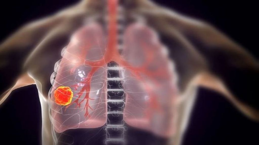 Científicos españoles desarrollan un tratamiento pionero para el cáncer de pulmón