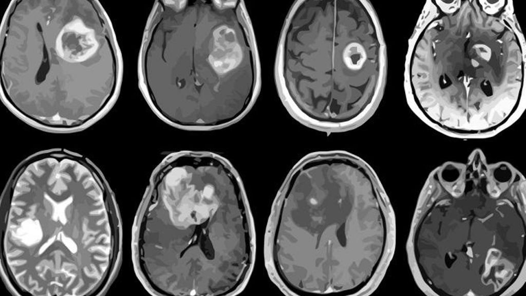 Archivo - Glioblastoma, tumor cerebral agresivo mapeado en detalle genético y molecular.