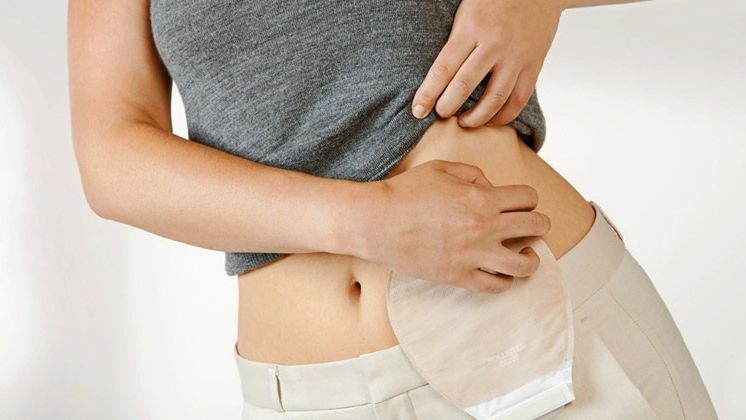 Un paciente ostomizado con su bolsa