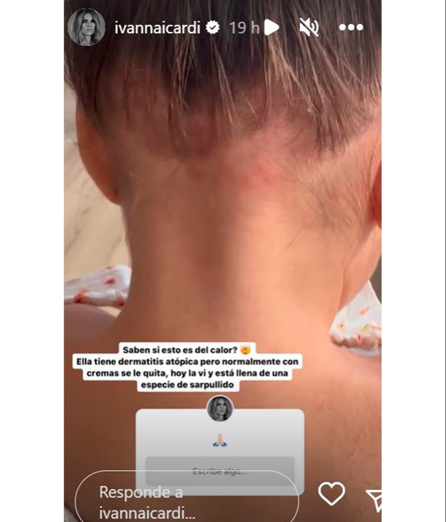 Ivana Icardi enseña la erupción en la piel que le ha salido a Giorgia