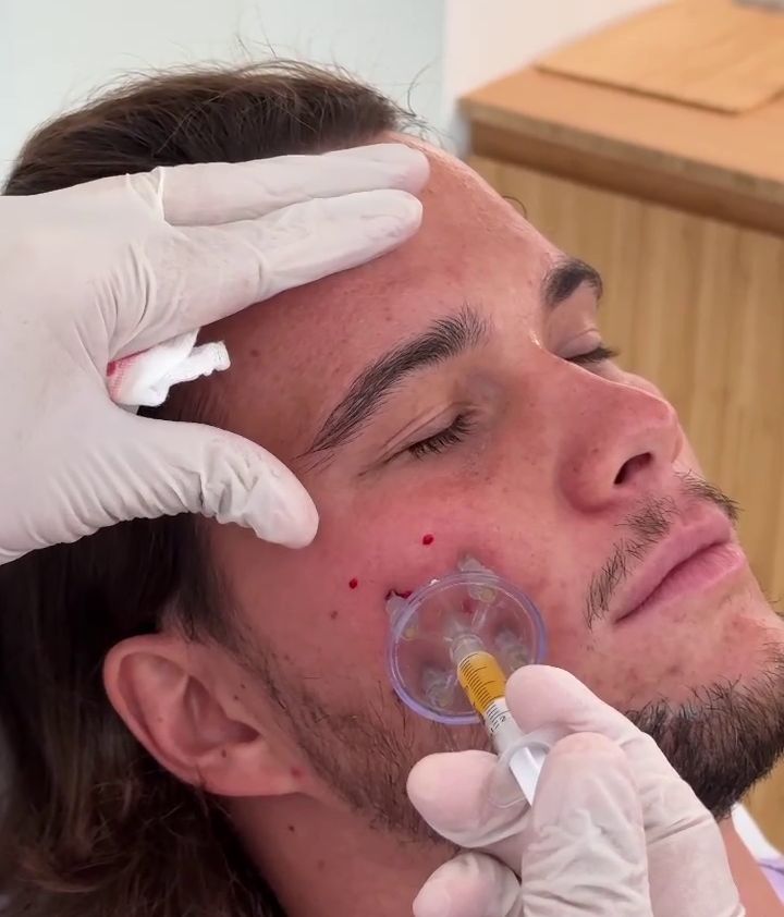 Bosco Blach Martínez-Bordiú se somete a un retoque estético en el rostro