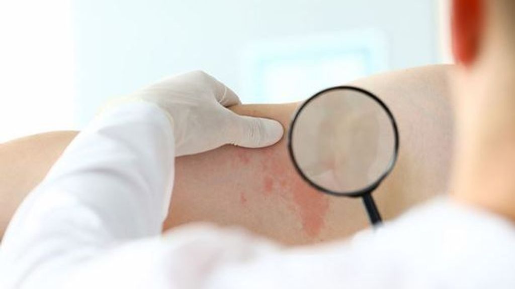 "El cáncer de piel es el cáncer más frecuente, del que mejor se saben las causas y que se puede prevenir"
