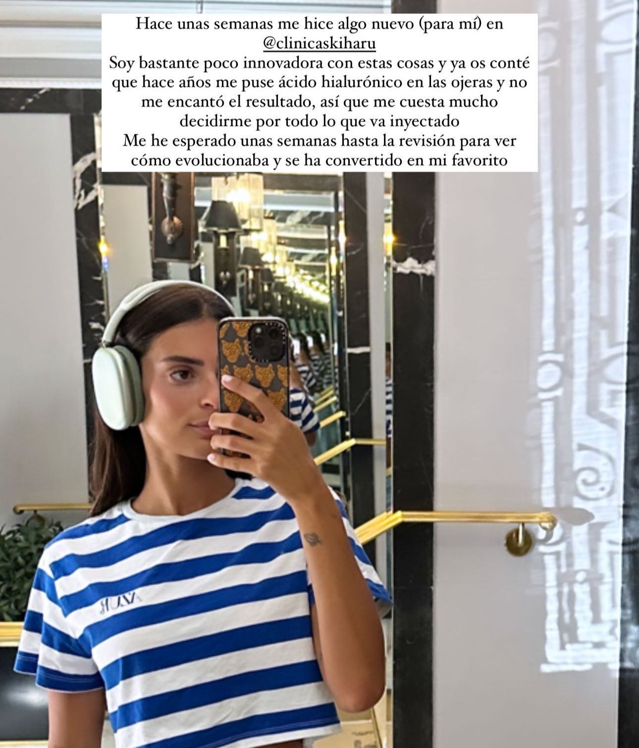 Susana Molina reconoce haberse sometido a un retoque estético en el rostro