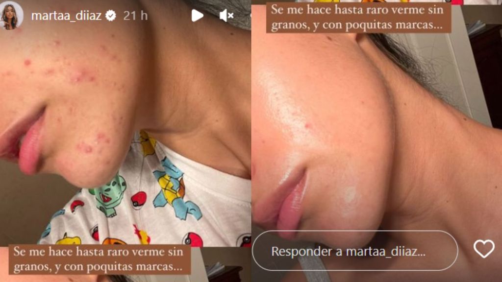 Acné de Marta Díaz