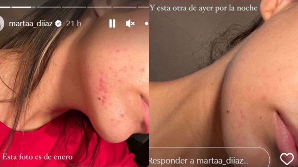 El acné de Marta Díaz