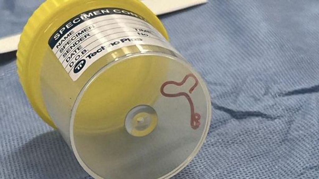 Cirujanos de Australia extraen una lombriz intestinal de 8 cm del cerebro de una mujer que creía tener cáncer