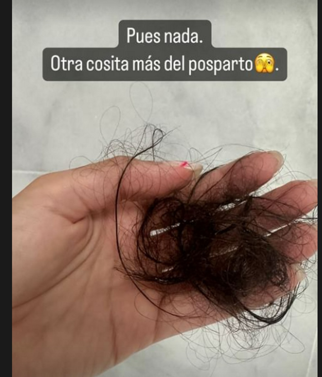 Cristina Pedroche enseña su caída de pelo