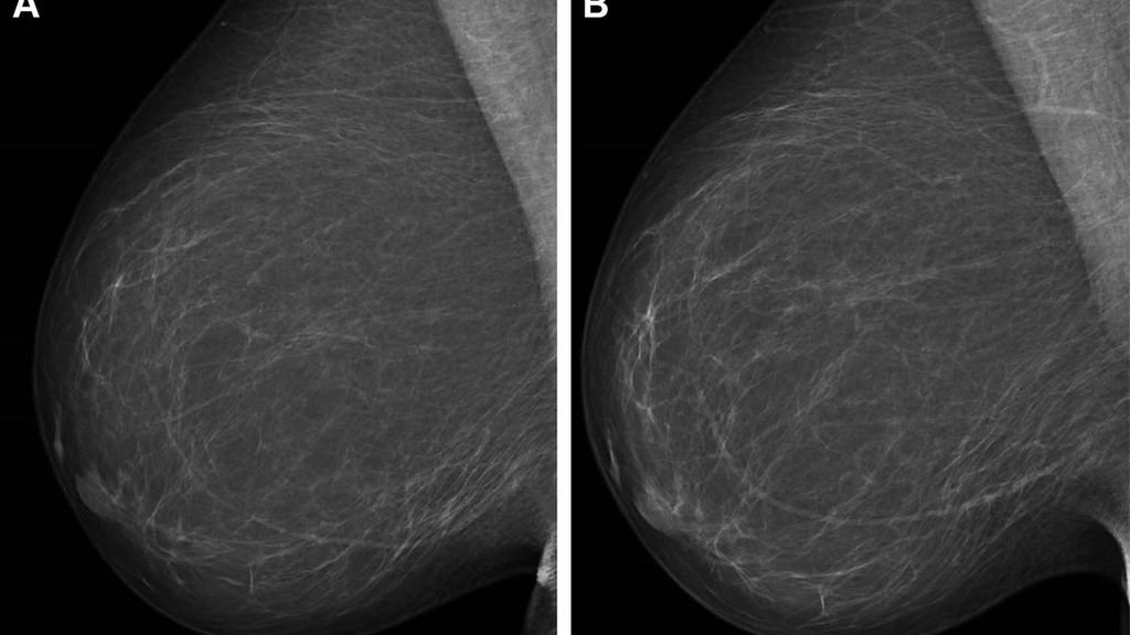 Mamografías digitales de campo completo (vista oblicua mediolateral derecha).