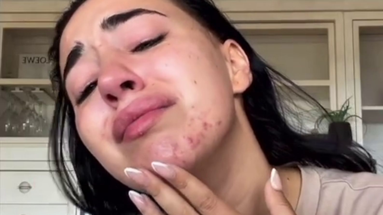 Carla Flila cries as she shows off pimples on her chin