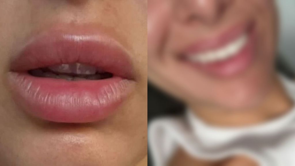 El antes y el después de Marina García tras retirarse el ácido hialurónico de sus labios