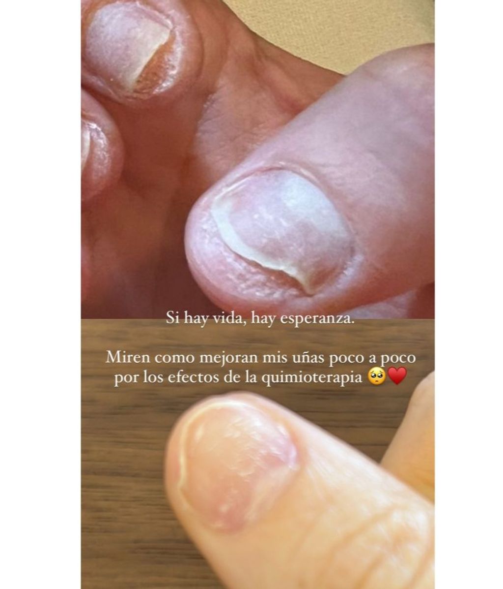 Aylén Milla muestra cómo quedaron sus uñas con la quimioterapia