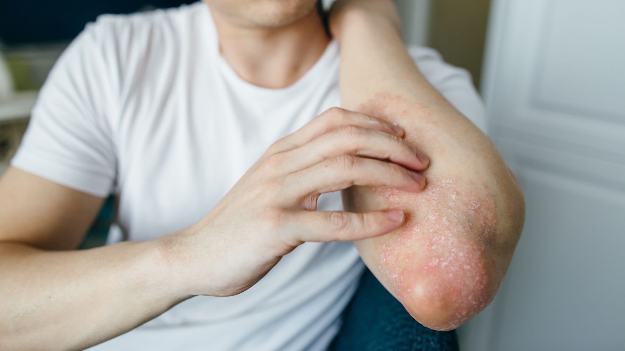 El 40% de los pacientes con Dermatitis Atópica necesitan atención psicológica debido a sus efectos