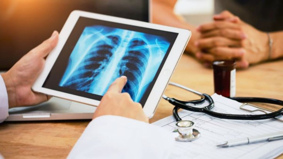 El 80% de los casos de cáncer de pulmón podrían ser curables si se detectan a tiempo