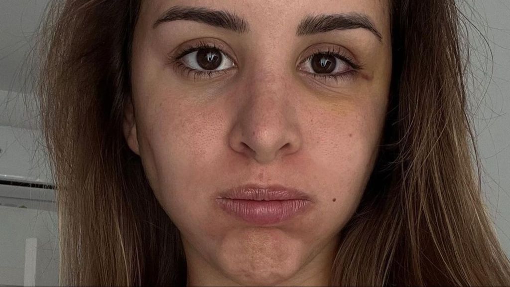 Marina García enseña su cara al natural tras una intervención médica