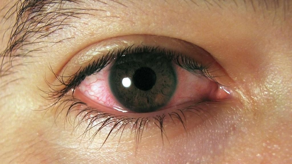 Archivo - Conjuntivitis. Ojos rojos.