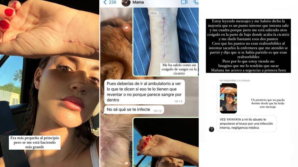 Melodie Peñalver enseña los coágulos que le han salido en la cicatriz de su brazo