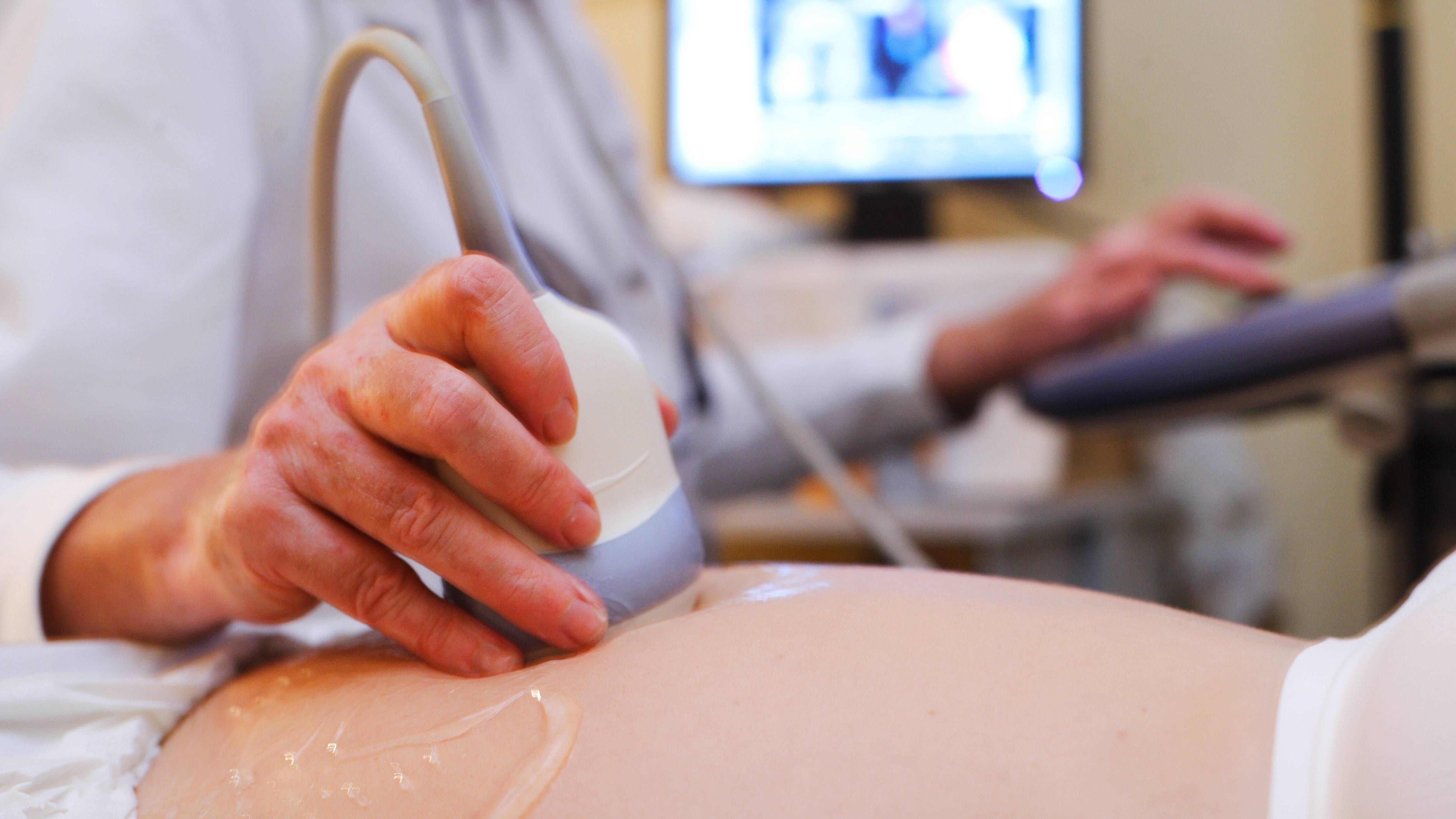 La arteria umbilical única se detecta con una ecografía. FUENTE: Cordonpress