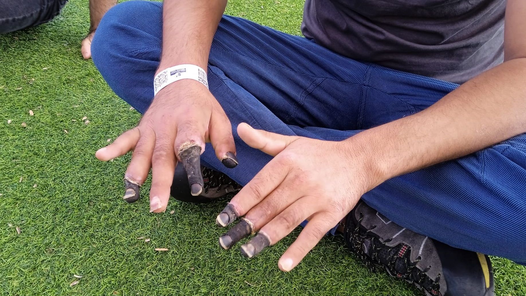 Murtaza sufrió severas congelaciones en los dedos de sus manos