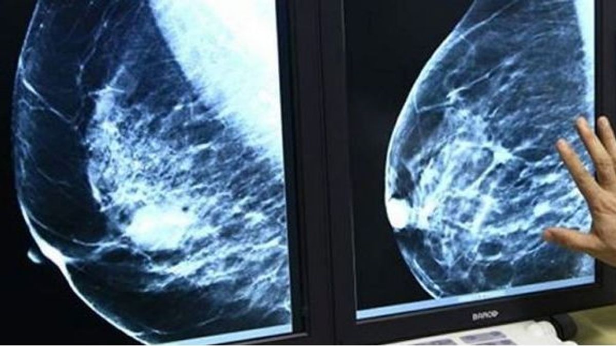El cáncer de mama metastásico es una enfermedad incurable y terminal