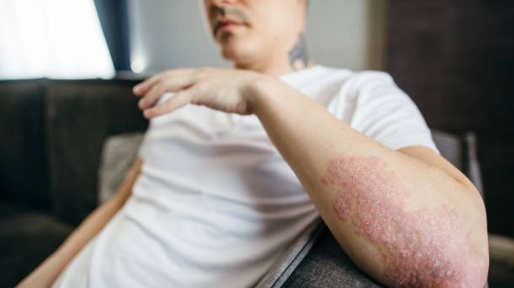 Día Mundial de la psoriasis: ¿cuáles son los alimentos que no se deben consumir?