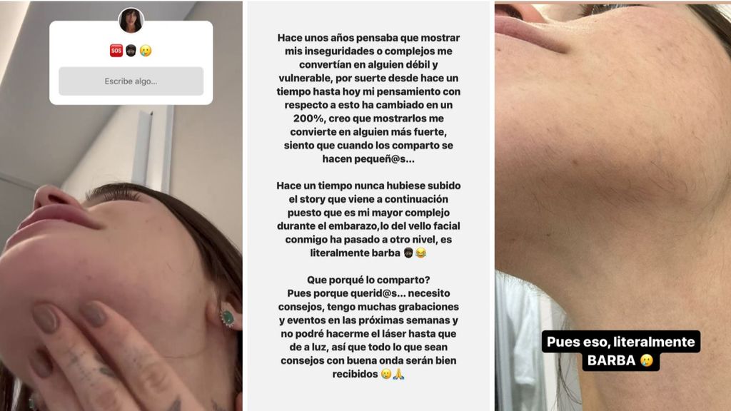 Violeta Mangriñán muestra su problema de vello facial que le ha salido durante el embarazo