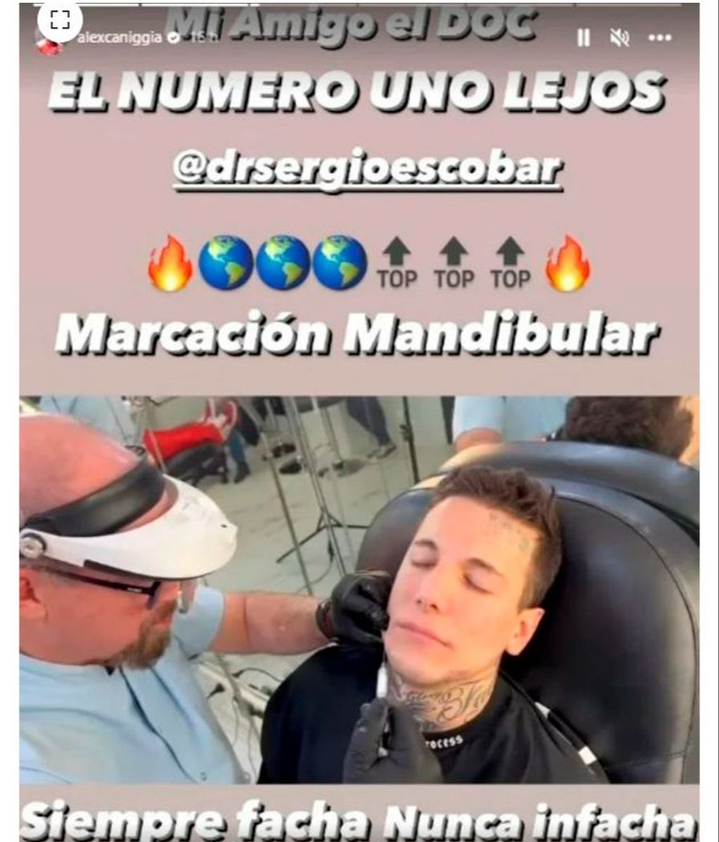 Alex Caniggia se ha sometido a una marcación mandibular