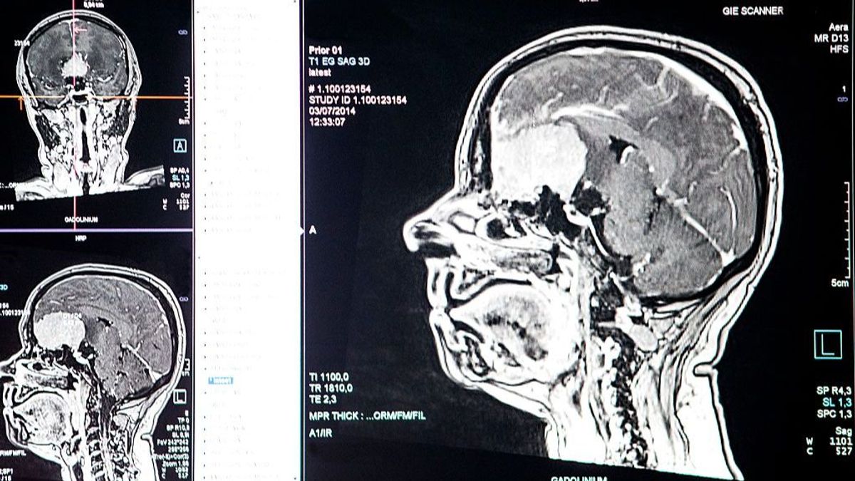 Predecir la muerte súbita, el nuevo reto conseguido por la Inteligencia Artificial