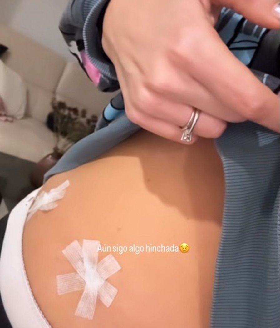 Marta Peñate enseña los puntos de su tripa