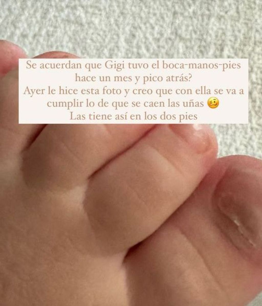 Ivana Icardi enseña las uñas de su hija tras padecer la enfermedad