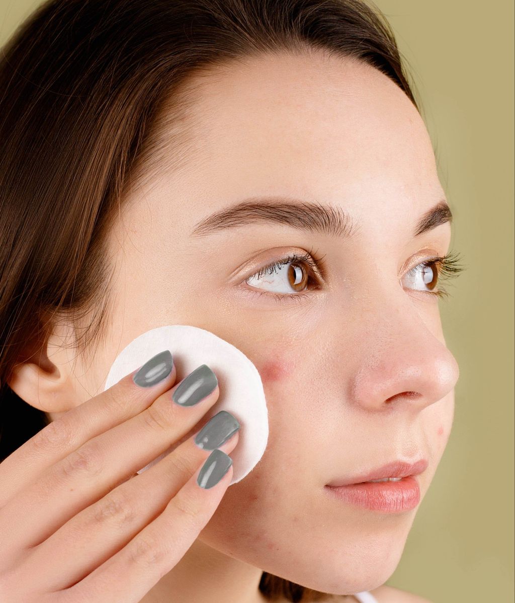El acné quístico aparece por un exceso de grasa en la piel. FUENTE: Pexels