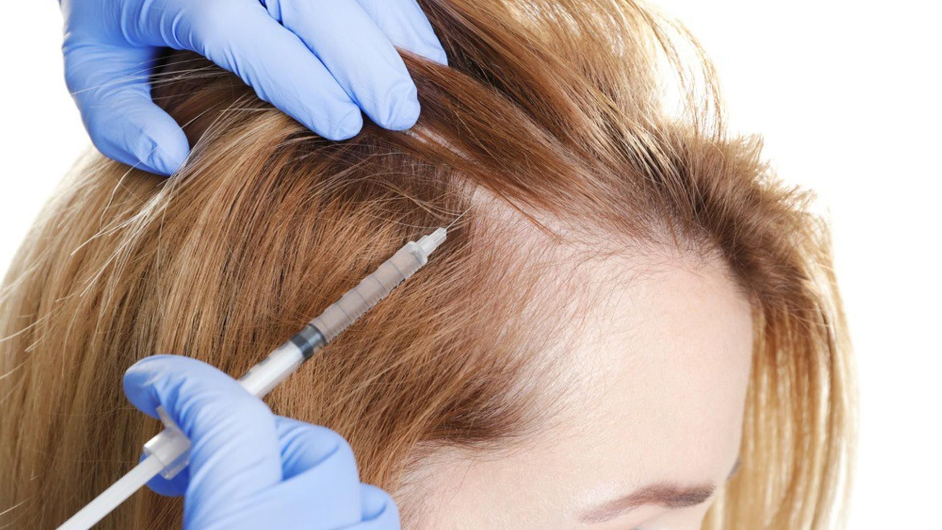 Archivo - Alopecia femenina.