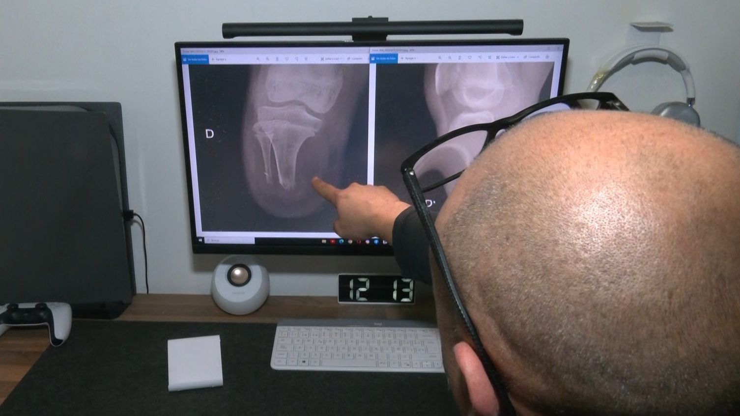 Hueso clavado en el músculo en una radiografía