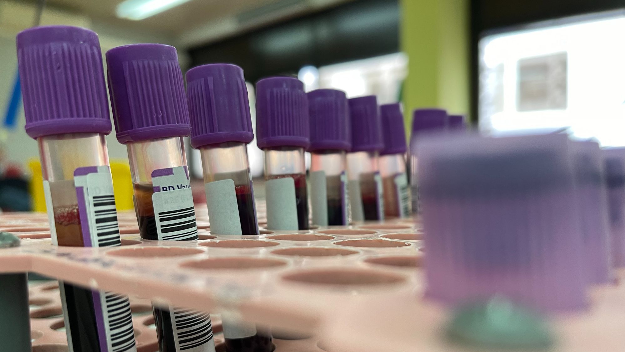 El 40% de los pacientes con viruela del mono presentan infección por VIH durante 2022