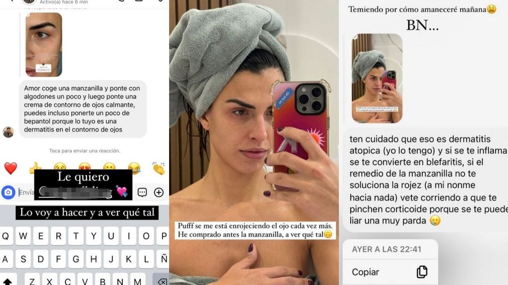 Sofía Suescun muestra el problema que le ha salido en los ojos