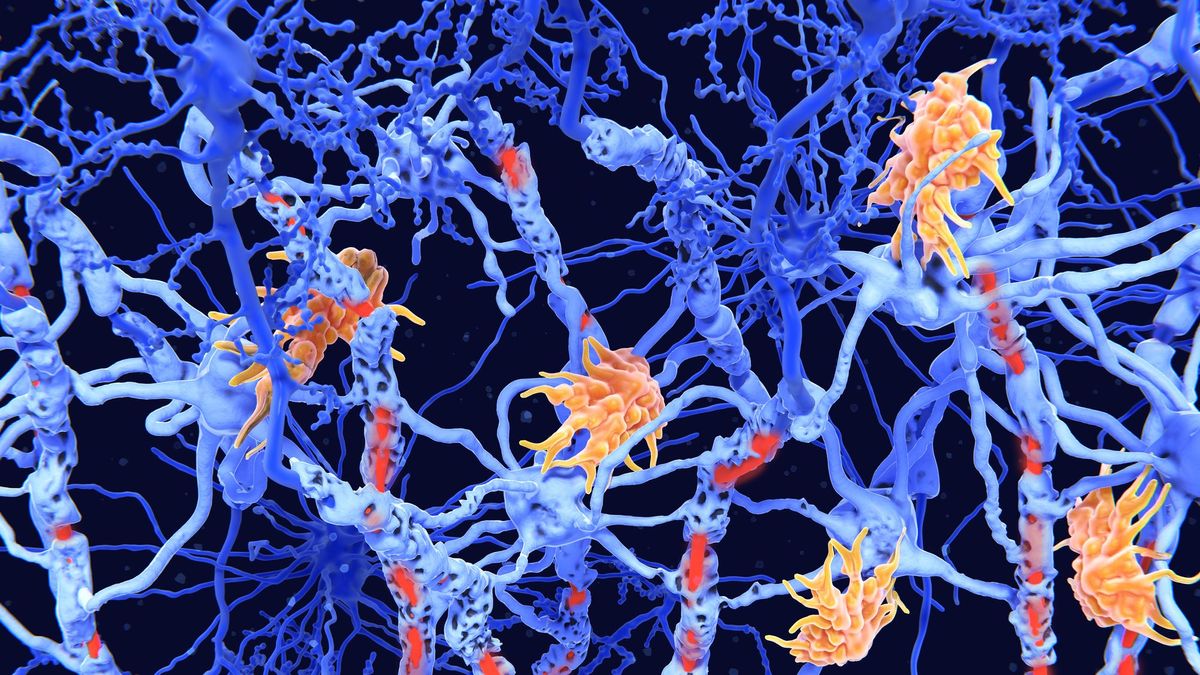 Descifran el enigma del origen de la esclerosis múltiple