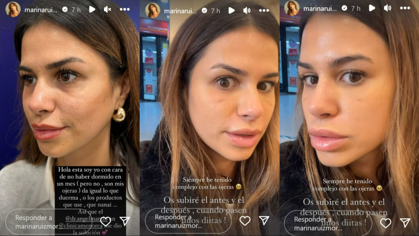 Marina Ruiz muestra el antes y el después de su retoque estético