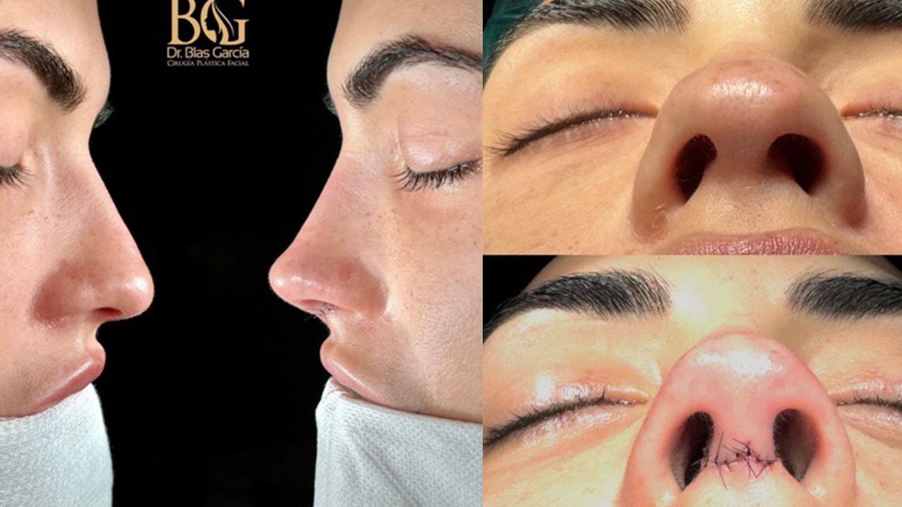 El resultado de la rinoplastia de Sofía Suescum