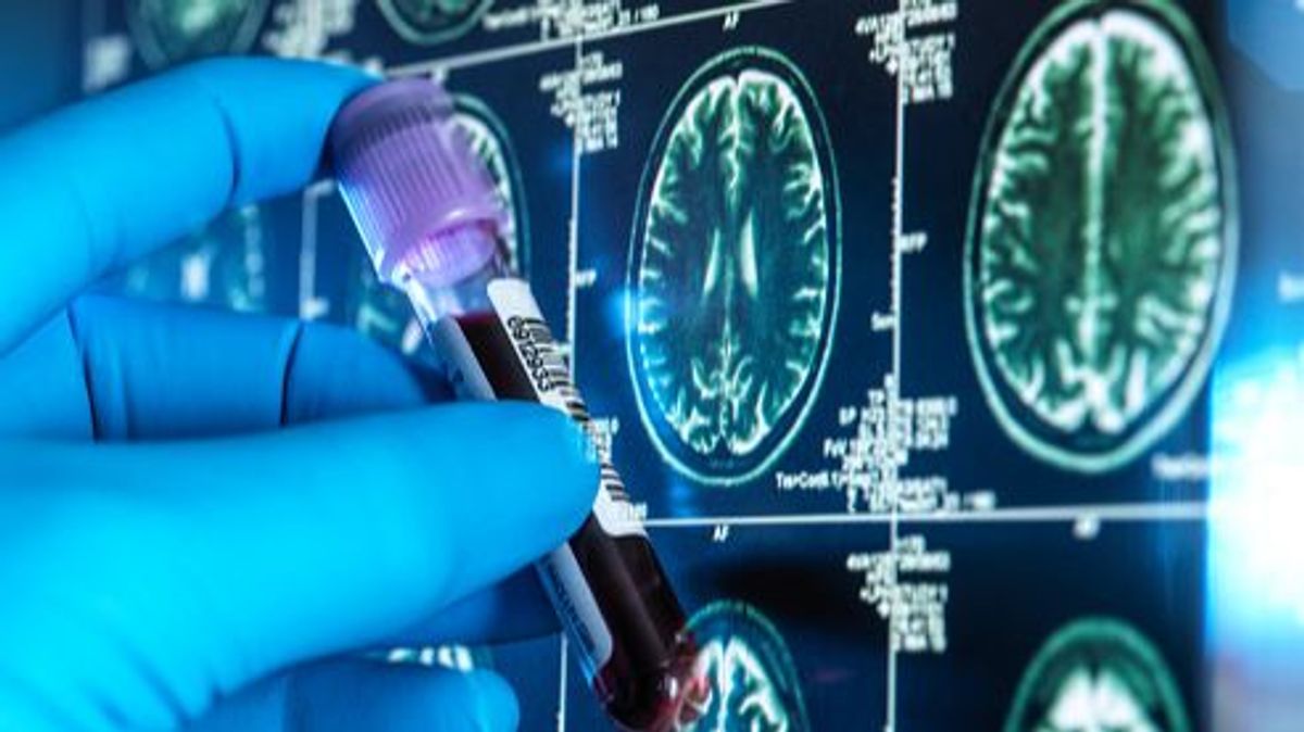 Investigación genética para conocer la predisposición a padecer alzhéimer