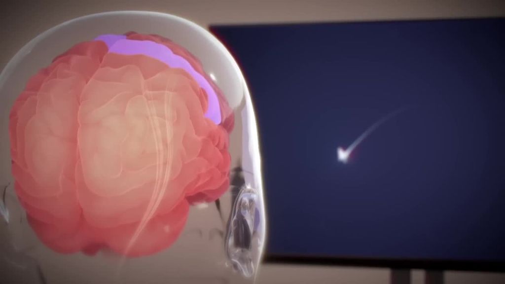 Elon Musk asegura que ha implantado el primer chip cerebral a un humano