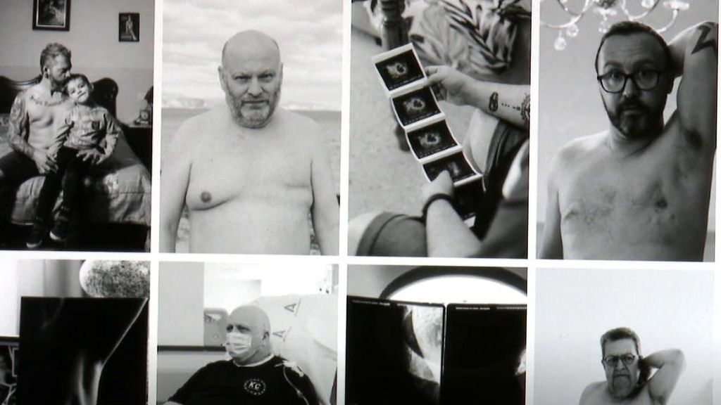 El desconocimiento hace que el cáncer de mama en hombres se detecte de forma tardía