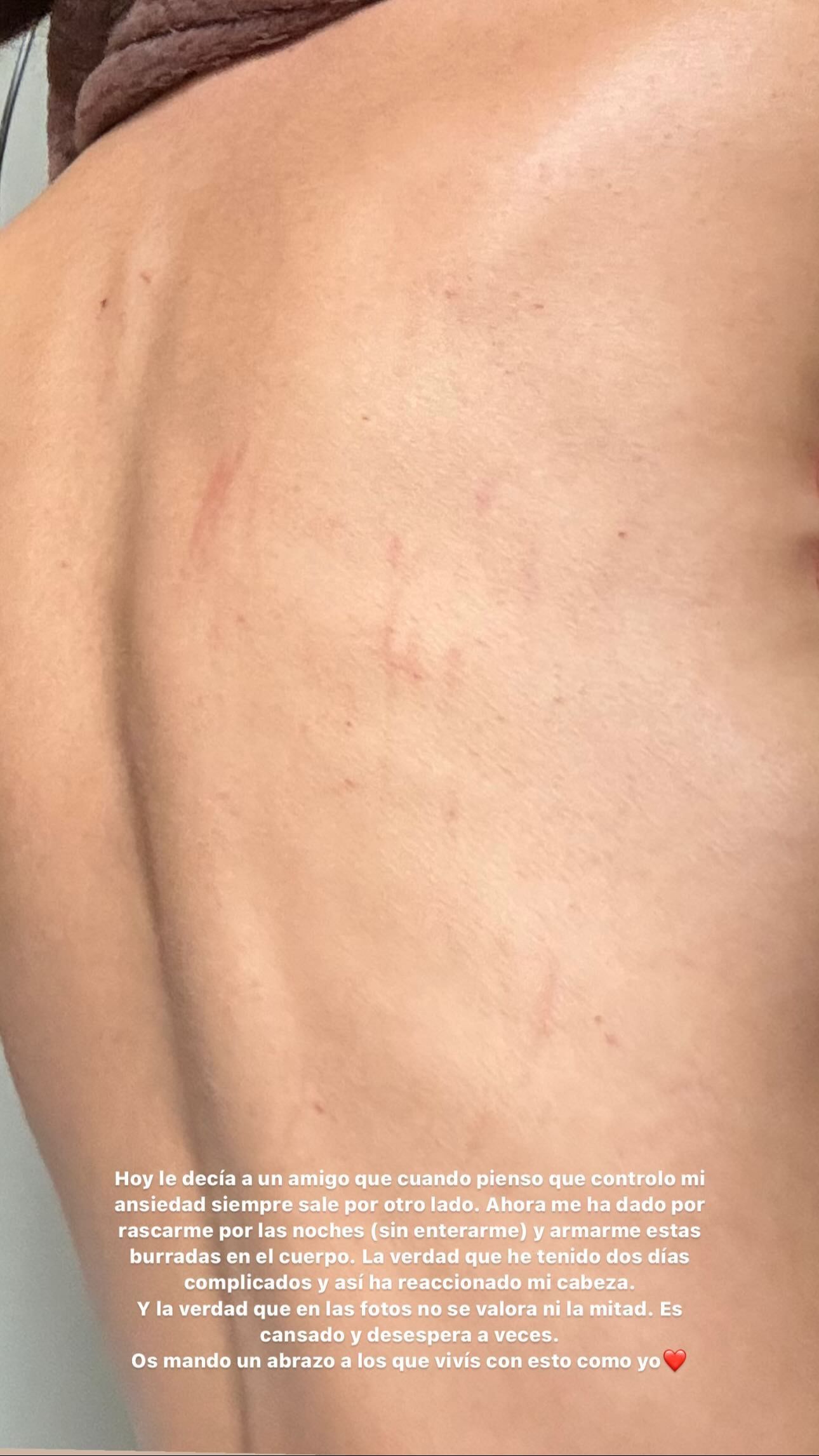 Las duras consecuencias de la ansiedad en el cuerpo de Lucía Rivera