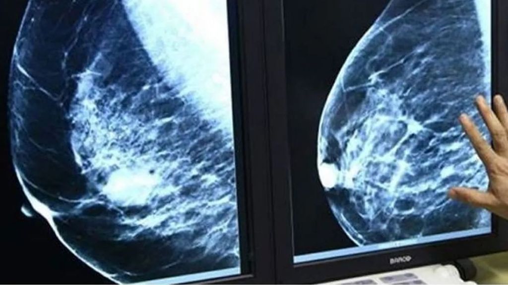 Un económico test de saliva podrá detectar el cáncer de mama en solo unos segundos