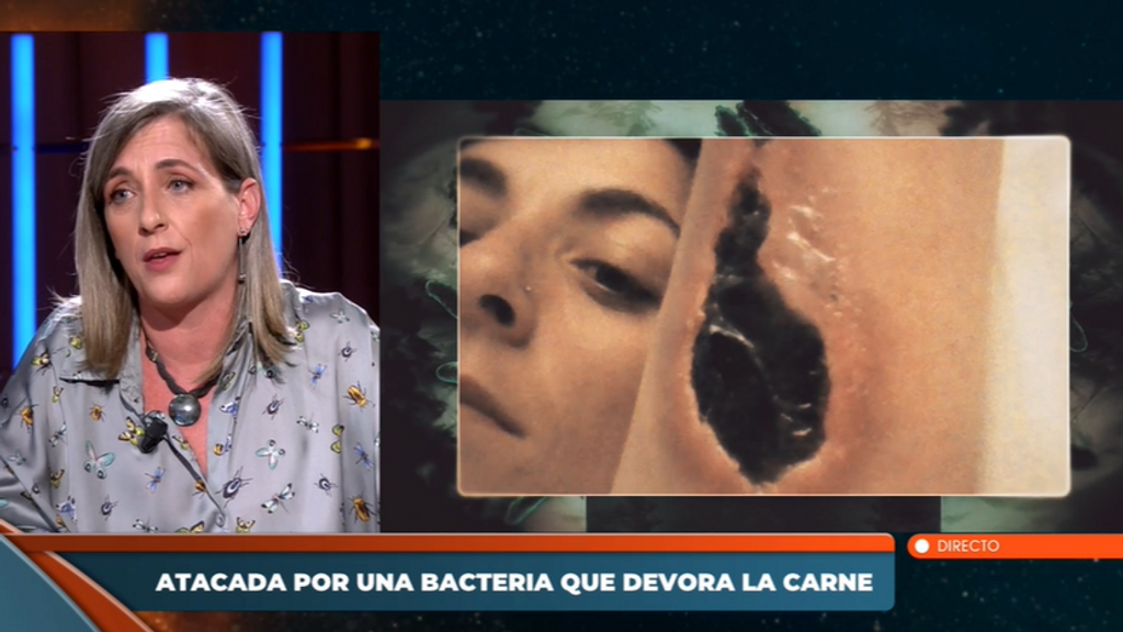 Patricia, la primera española atacada por la bacteria que devora la carne humana: “Estuve ingresada dos meses y casi pierdo el brazo por necrosis”