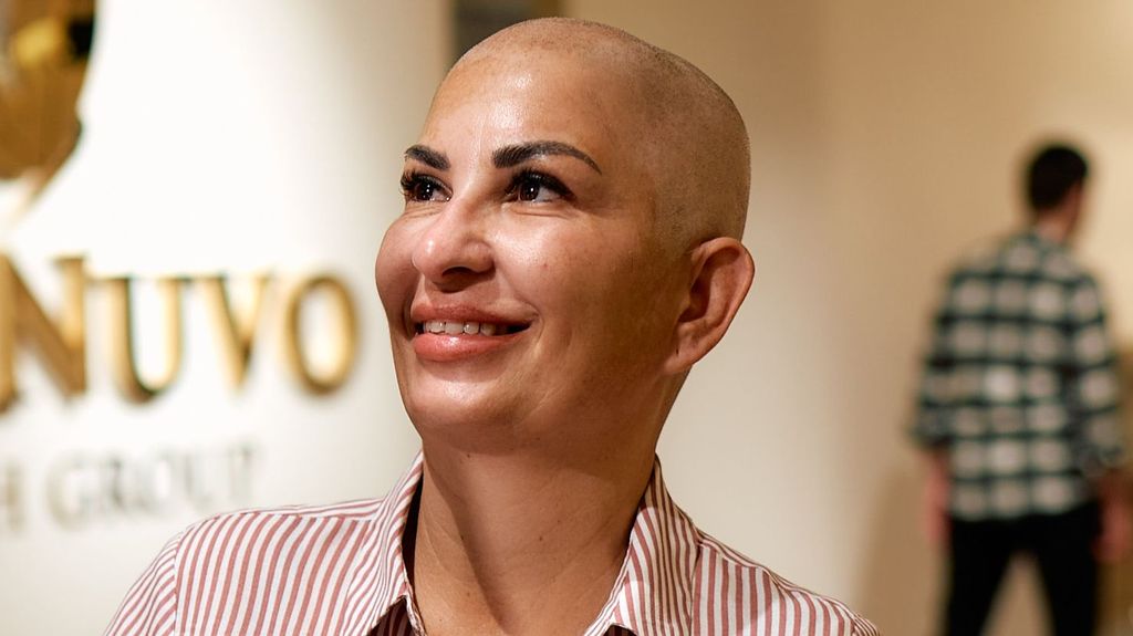 Malu visibiliza el trasplante capilar femenino: "Llevo diez años intentando acabar con mi alopecia"