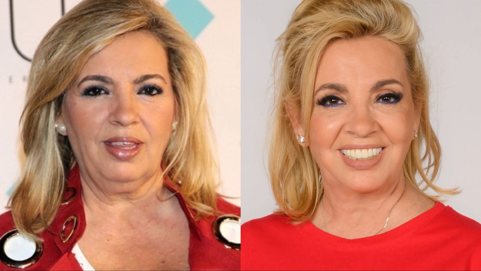 El antes y después de todos los retoques estéticos de Carmen Borrego