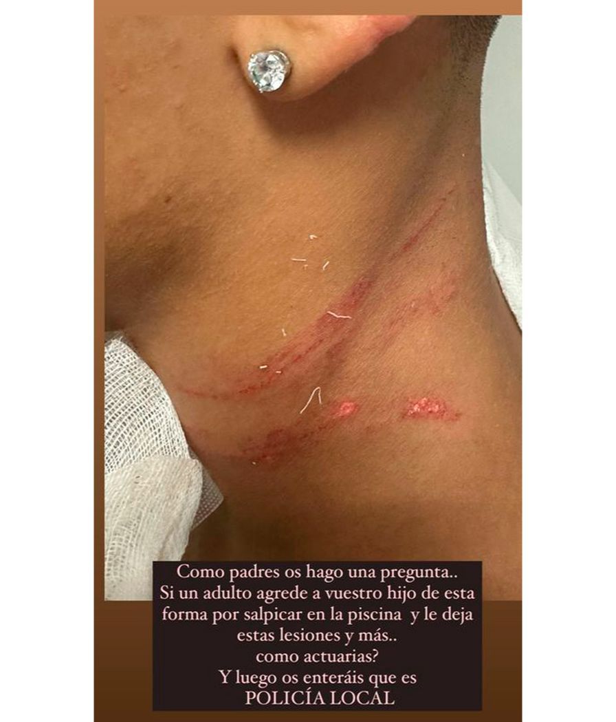 Fani Carbajo muestra las señales de su hijo Emilio en el cuello tras la agresión